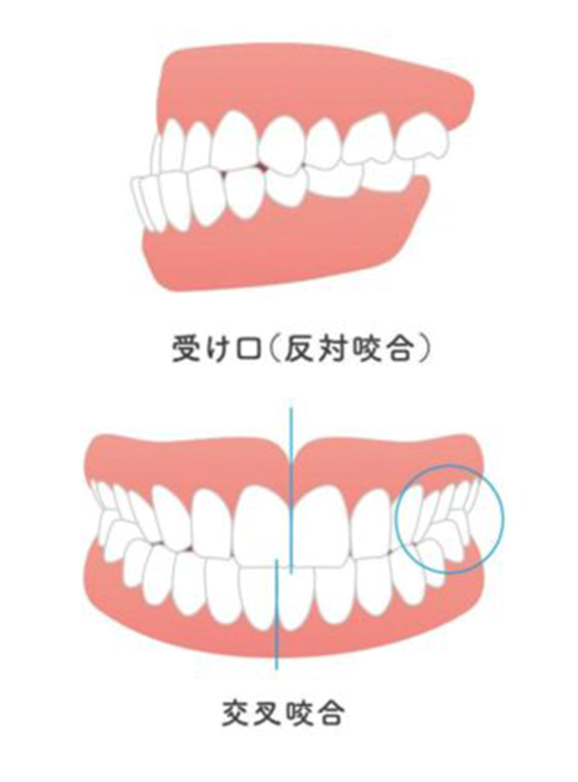 矢口渡・池上・蓮沼・武蔵新田・蒲田の歯医者、のびのび歯科・矯正歯科の反対咬合（下顎前突、受け口）治療