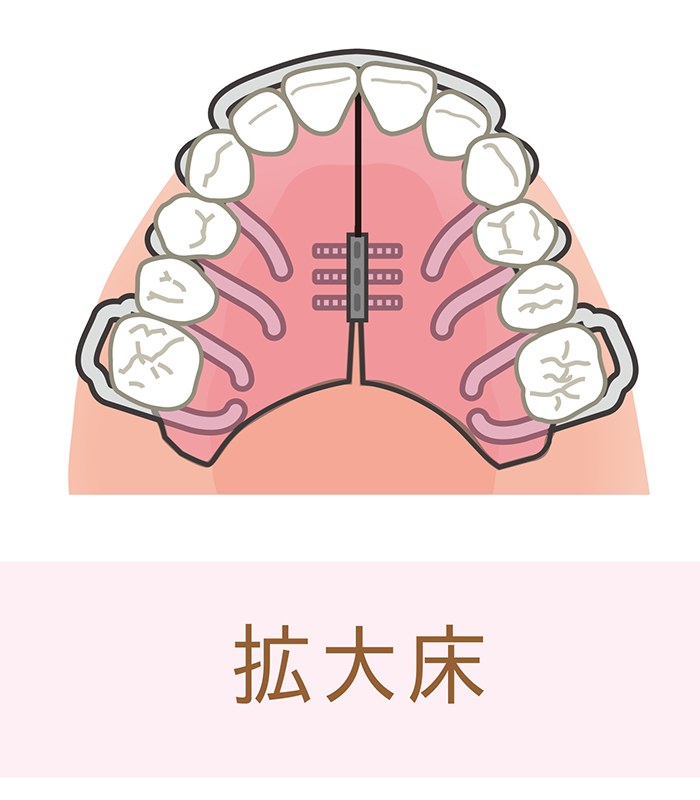 矢口渡・池上・武蔵新田、のびのび歯科・矯正歯科で使用する装置ついての解説