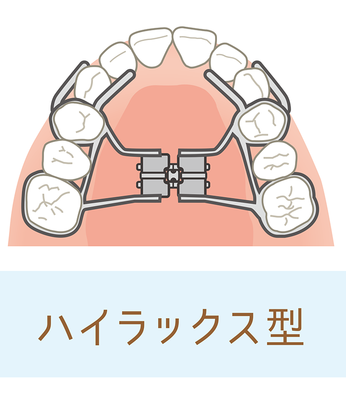 矢口渡・池上・武蔵新田、のびのび歯科・矯正歯科で使用する装置ついての解説