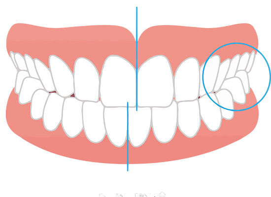 矢口渡・池上・武蔵新田、のびのび歯科・矯正歯科で交叉咬合（噛み合わせのズレ）の矯正治療